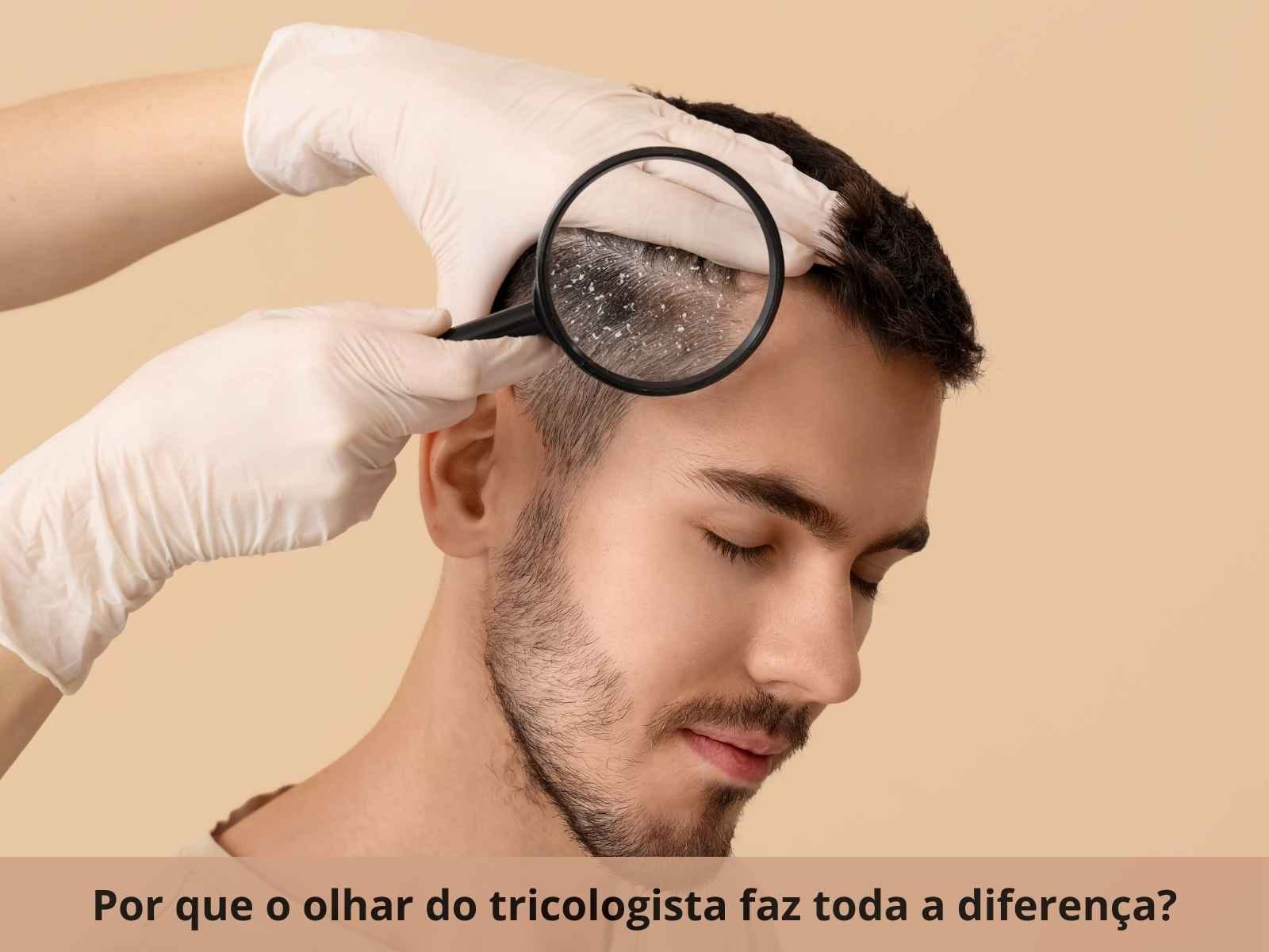 tratamento para caspa